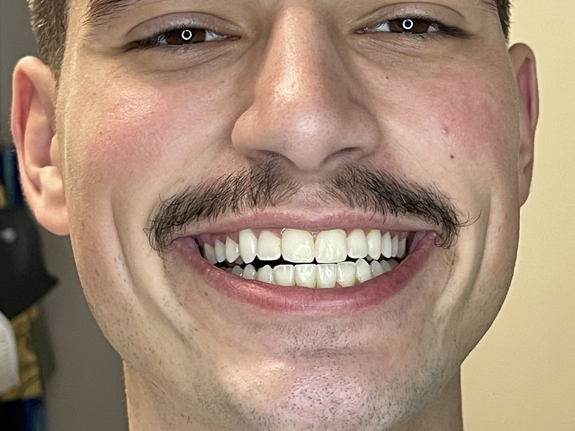 Sorriso de paciente antes do clareamento