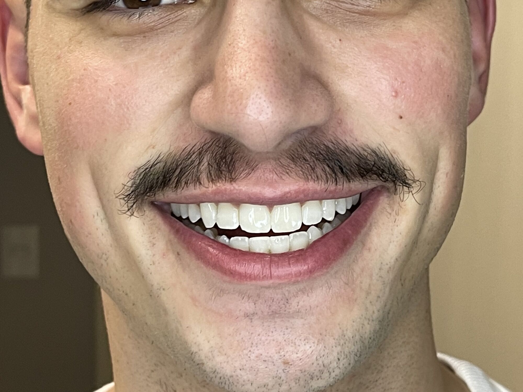 Sorriso de paciente depois do clareamento